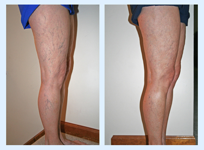 Chronic Venous Insufficiency  Vascular Treatment in New Jersey