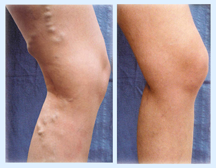 Can Varicose Veins Come Back After Treatment?: Northwest Houston Heart  Center: Cardiology